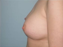 Breast Augmentation After Photo by Richard Wassermann, MD, MPH, FACS; Columbia, SC - Case 22069