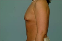 Breast Augmentation Before Photo by Richard Wassermann, MD, MPH, FACS; Columbia, SC - Case 22069