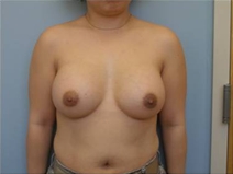 Breast Augmentation After Photo by Richard Wassermann, MD, MPH, FACS; Columbia, SC - Case 22071