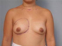 Breast Augmentation Before Photo by Richard Wassermann, MD, MPH, FACS; Columbia, SC - Case 22071