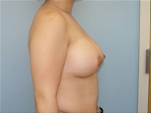 Breast Augmentation After Photo by Richard Wassermann, MD, MPH, FACS; Columbia, SC - Case 22071