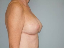 Breast Augmentation After Photo by Richard Wassermann, MD, MPH, FACS; Columbia, SC - Case 22073