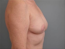 Breast Augmentation Before Photo by Richard Wassermann, MD, MPH, FACS; Columbia, SC - Case 22073