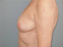 Breast Augmentation Before Photo by Richard Wassermann, MD, MPH, FACS; Columbia, SC - Case 22073