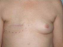 Breast Reconstruction Before Photo by Richard Wassermann, MD, MPH, FACS; Columbia, SC - Case 22074