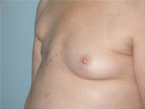 Breast Reconstruction Before Photo by Richard Wassermann, MD, MPH, FACS; Columbia, SC - Case 22074