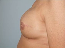 Breast Reconstruction After Photo by Richard Wassermann, MD, MPH, FACS; Columbia, SC - Case 22074