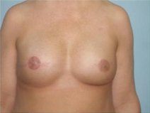 Breast Reconstruction After Photo by Richard Wassermann, MD, MPH, FACS; Columbia, SC - Case 22074