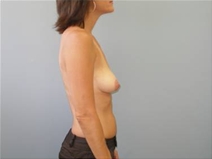 Breast Augmentation Before Photo by Richard Wassermann, MD, MPH, FACS; Columbia, SC - Case 22075