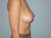 Breast Lift After Photo by Richard Wassermann, MD, MPH, FACS; Columbia, SC - Case 22076