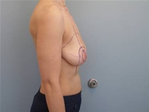 Breast Lift Before Photo by Richard Wassermann, MD, MPH, FACS; Columbia, SC - Case 22076