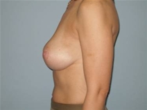 Breast Lift After Photo by Richard Wassermann, MD, MPH, FACS; Columbia, SC - Case 22076