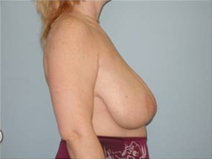 Breast Reduction Before Photo by Richard Wassermann, MD, MPH, FACS; Columbia, SC - Case 22078