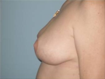 Breast Reduction After Photo by Richard Wassermann, MD, MPH, FACS; Columbia, SC - Case 22078
