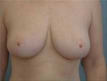 Breast Reduction After Photo by Richard Wassermann, MD, MPH, FACS; Columbia, SC - Case 22079