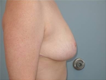Breast Reduction After Photo by Richard Wassermann, MD, MPH, FACS; Columbia, SC - Case 22079
