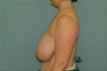 Breast Reduction Before Photo by Richard Wassermann, MD, MPH, FACS; Columbia, SC - Case 22079
