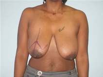 Breast Reduction Before Photo by Richard Wassermann, MD, MPH, FACS; Columbia, SC - Case 22080