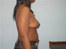 Breast Reduction After Photo by Richard Wassermann, MD, MPH, FACS; Columbia, SC - Case 22080