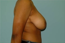 Breast Reduction Before Photo by Richard Wassermann, MD, MPH, FACS; Columbia, SC - Case 22080