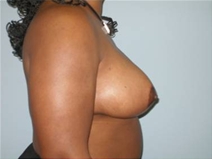 Breast Reduction After Photo by Richard Wassermann, MD, MPH, FACS; Columbia, SC - Case 22082