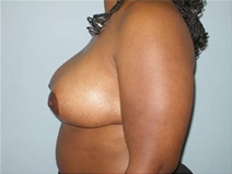 Breast Reduction After Photo by Richard Wassermann, MD, MPH, FACS; Columbia, SC - Case 22082