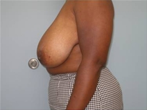 Breast Reduction Before Photo by Richard Wassermann, MD, MPH, FACS; Columbia, SC - Case 22082