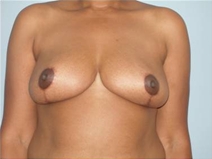 Breast Reduction After Photo by Richard Wassermann, MD, MPH, FACS; Columbia, SC - Case 22083