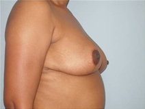 Breast Reduction After Photo by Richard Wassermann, MD, MPH, FACS; Columbia, SC - Case 22083