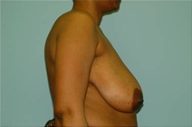 Breast Reduction Before Photo by Richard Wassermann, MD, MPH, FACS; Columbia, SC - Case 22083