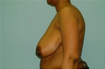 Breast Reduction Before Photo by Richard Wassermann, MD, MPH, FACS; Columbia, SC - Case 22083