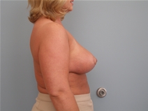 Breast Lift After Photo by Richard Wassermann, MD, MPH, FACS; Columbia, SC - Case 22164