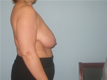 Breast Lift Before Photo by Richard Wassermann, MD, MPH, FACS; Columbia, SC - Case 22164