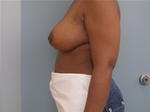 Breast Lift After Photo by Richard Wassermann, MD, MPH, FACS; Columbia, SC - Case 22165