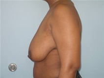 Breast Lift Before Photo by Richard Wassermann, MD, MPH, FACS; Columbia, SC - Case 22165