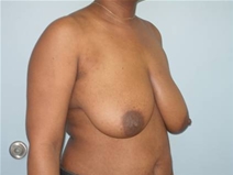 Breast Lift Before Photo by Richard Wassermann, MD, MPH, FACS; Columbia, SC - Case 22165