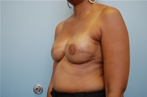 Breast Reconstruction After Photo by Richard Wassermann, MD, MPH, FACS; Columbia, SC - Case 22250