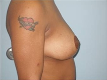 Breast Reduction After Photo by Richard Wassermann, MD, MPH, FACS; Columbia, SC - Case 22251