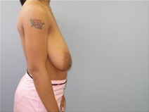 Breast Reduction Before Photo by Richard Wassermann, MD, MPH, FACS; Columbia, SC - Case 22251