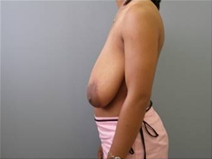 Breast Reduction Before Photo by Richard Wassermann, MD, MPH, FACS; Columbia, SC - Case 22251