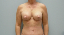 Breast Lift After Photo by Richard Wassermann, MD, MPH, FACS; Columbia, SC - Case 22254