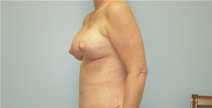 Breast Lift After Photo by Richard Wassermann, MD, MPH, FACS; Columbia, SC - Case 22254