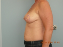 Breast Lift Before Photo by Richard Wassermann, MD, MPH, FACS; Columbia, SC - Case 22254