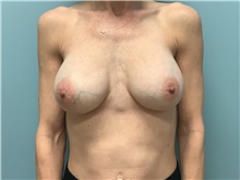 Breast Augmentation After Photo by Richard Wassermann, MD, MPH, FACS; Columbia, SC - Case 48943