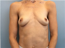 Breast Augmentation Before Photo by Richard Wassermann, MD, MPH, FACS; Columbia, SC - Case 48943