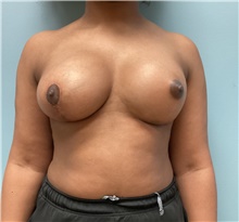 Breast Augmentation After Photo by Richard Wassermann, MD, MPH, FACS; Columbia, SC - Case 48945