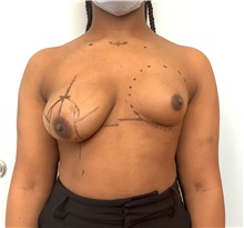 Breast Augmentation Before Photo by Richard Wassermann, MD, MPH, FACS; Columbia, SC - Case 48945