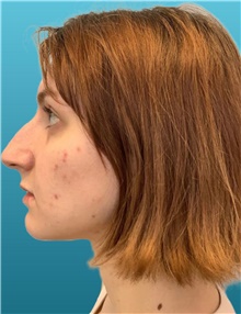 Rhinoplasty Before Photo by Richard Wassermann, MD, MPH, FACS; Columbia, SC - Case 48946