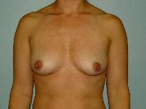 Breast Augmentation Before Photo by Richard Wassermann, MD, MPH, FACS; Columbia, SC - Case 6575