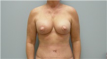 Breast Lift After Photo by Richard Wassermann, MD, MPH, FACS; Columbia, SC - Case 22254